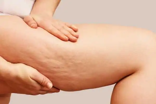 Image of woman showing leg with cellulite Yorkhill