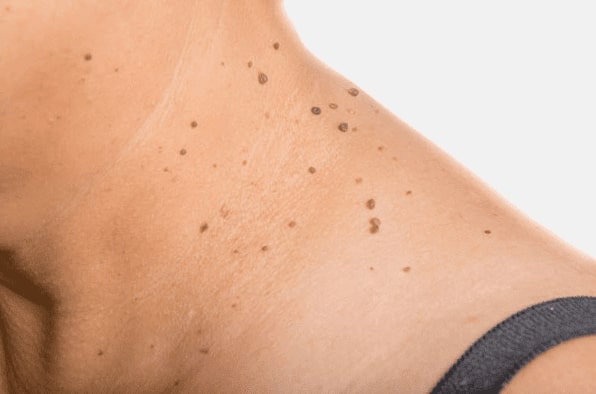Are you looking for easy skin tag removal Yorkhill - then contact Spire today!