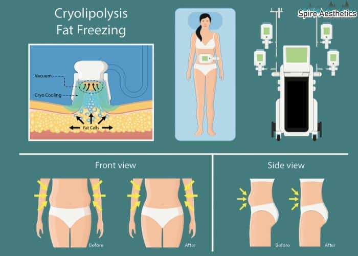 Image of diet and fat freezing combined for best results for Spire Aesthetics Yorkhill