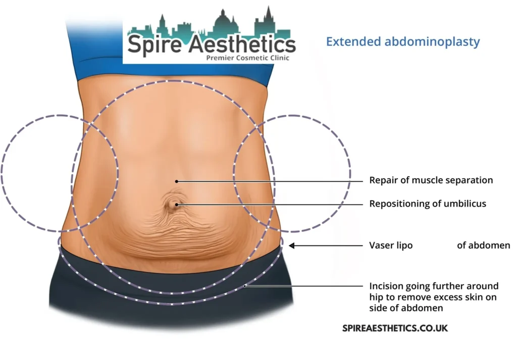 Understanding Loose Skin After Gastric Band Yorkhill Surgery and HIFU Treatment