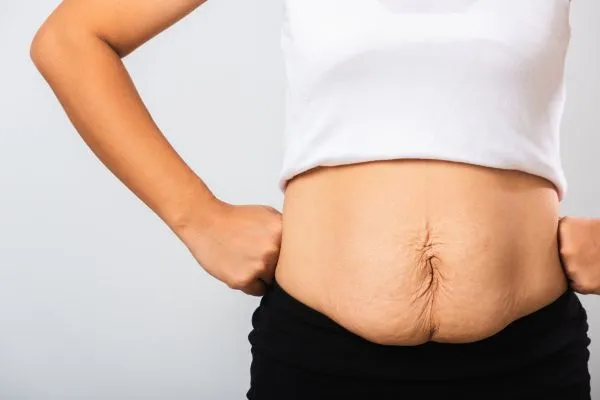 Image of a woman's stomach after weight loss with sagging skin following a gastric band Yorkhill