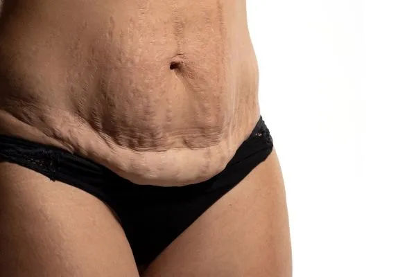 Image of womans stomach after weight loss injections Yorkhill showing saggy skin